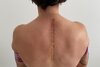 Bild zum Inhalt: Ana Carrasco: Metallteile im Rücken operativ entfernt