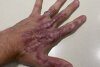 Bild zum Inhalt: Romain Grosjean: Neue Haut für die linke Hand