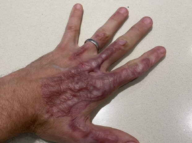Titel-Bild zur News: Die linke Hand von Romain Grosjean vor der Hauttransplantation