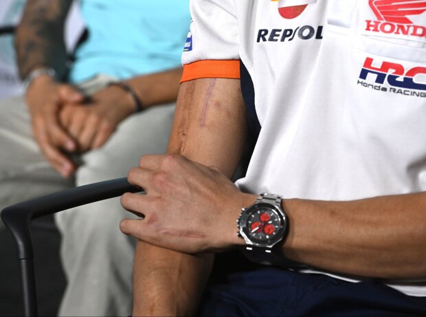Marc Marquez Narben Marc Marquez Narben